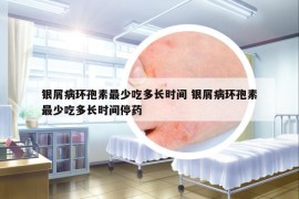银屑病环孢素最少吃多长时间 银屑病环孢素最少吃多长时间停药