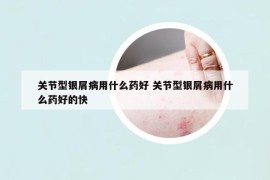 关节型银屑病用什么药好 关节型银屑病用什么药好的快