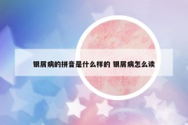 银屑病的拼音是什么样的 银屑病怎么读