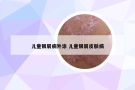 儿童银屑病外涂 儿童银屑皮肤病