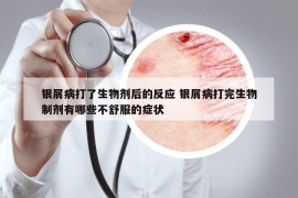 银屑病打了生物剂后的反应 银屑病打完生物制剂有哪些不舒服的症状