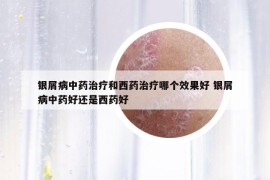 银屑病中药治疗和西药治疗哪个效果好 银屑病中药好还是西药好