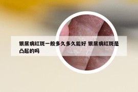 银屑病红斑一般多久多久能好 银屑病红斑是凸起的吗