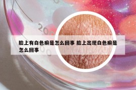 脸上有白色癣是怎么回事 脸上出现白色癣是怎么回事