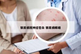 银屑病视神经苍白 银屑病眼睛