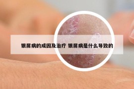 银屑病的成因及治疗 银屑病是什么导致的