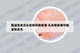 脂溢性皮炎头皮屑和银屑病 头皮银屑病与脂溢性皮炎