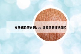 皮肤病拍照自测app 银癣早期症状图片