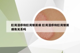 肛周湿疹和肛周银屑病 肛周湿疹和肛周银屑病有关系吗