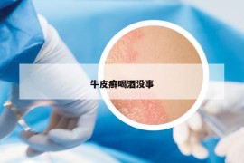 牛皮癣喝酒没事