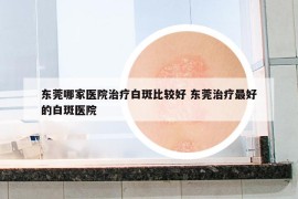 东莞哪家医院治疗白斑比较好 东莞治疗最好的白斑医院