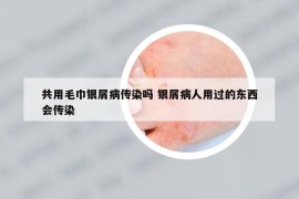 共用毛巾银屑病传染吗 银屑病人用过的东西会传染