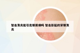 智齿发炎能引出银屑病吗 智齿影起的牙银发炎