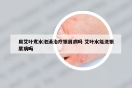 用艾叶煮水泡澡治疗银屑病吗 艾叶水能洗银屑病吗