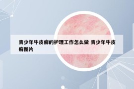 青少年牛皮癣的护理工作怎么做 青少年牛皮癣图片