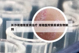 长沙湘雅银屑病治疗 湘雅医院银屑病生物制剂