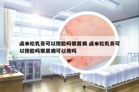 卤米松乳膏可以擦脸吗银屑病 卤米松乳膏可以擦脸吗银屑病可以用吗