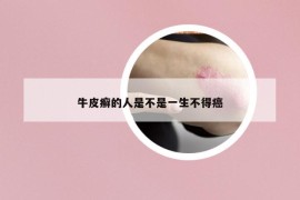 牛皮癣的人是不是一生不得癌