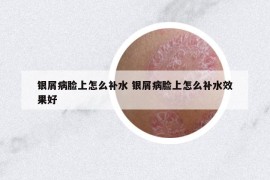 银屑病脸上怎么补水 银屑病脸上怎么补水效果好