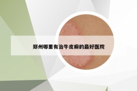 郑州哪里有治牛皮癣的最好医院