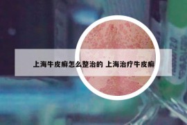 上海牛皮癣怎么整治的 上海治疗牛皮癣