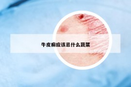 牛皮癣应该忌什么蔬菜