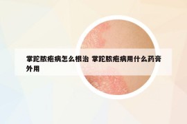 掌跎脓疱病怎么根治 掌跎脓疱病用什么药膏外用