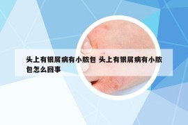 头上有银屑病有小脓包 头上有银屑病有小脓包怎么回事