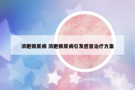浓胞银屑病 浓胞银屑病引发感冒治疗方案