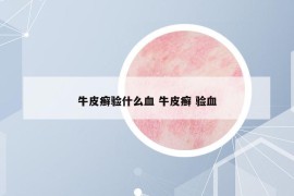 牛皮癣验什么血 牛皮癣 验血