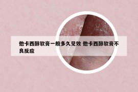 他卡西醇软膏一般多久见效 他卡西醇软膏不良反应