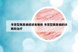 寻常型银屑病症状有哪些 寻常型银屑病的诊断和治疗