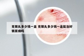 克银丸多少钱一盒 克银丸多少钱一盒能治好银屑病吗