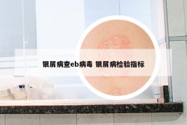 银屑病查eb病毒 银屑病检验指标