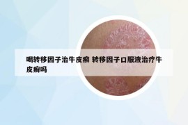 喝转移因子治牛皮癣 转移因子口服液治疗牛皮癣吗