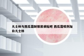 凡士林与西瓜霜制银屑病贴吧 西瓜霜喷剂加白凡士林