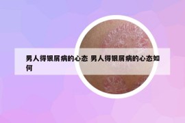 男人得银屑病的心态 男人得银屑病的心态如何