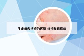 牛皮癣和疥疮的区别 疥疮和银屑病