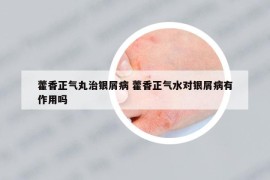 藿香正气丸治银屑病 藿香正气水对银屑病有作用吗