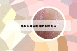 牛皮癣咋来的 牛皮癣的起因