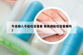 牛皮癣人不能吃百香果 银屑病能吃百香果吗?