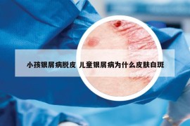 小孩银屑病脱皮 儿童银屑病为什么皮肤白斑
