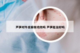 芦笋对牛皮癣有功效吗 芦笋能治好吗
