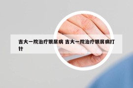 吉大一院治疗银屑病 吉大一院治疗银屑病打针
