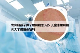发育期孩子得了银屑病怎么办 儿童患银屑病长大了病情会轻吗