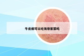 牛皮癣可以吃海带紫菜吗