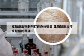 皮肤病生物制剂打在身体哪里 生物制剂治疗皮肤病的原理