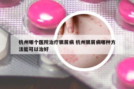 杭州哪个医院治疗银屑病 杭州银屑病哪种方法能可以治好