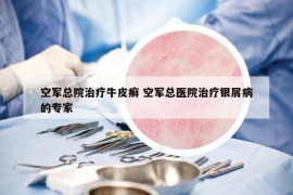 空军总院治疗牛皮癣 空军总医院治疗银屑病的专家