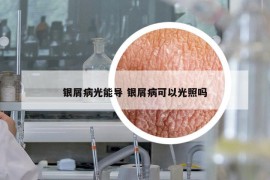 银屑病光能导 银屑病可以光照吗